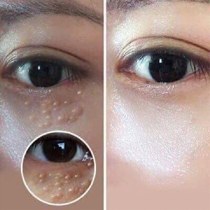 Tsubuporon Eye Essence 1.8ml, làm sạch da chết vùng mắt, giảm mụn thương hiệu 